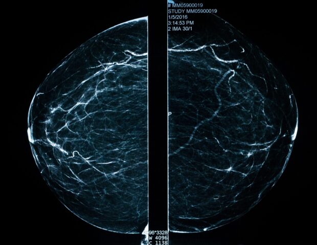 Mammogram xray image